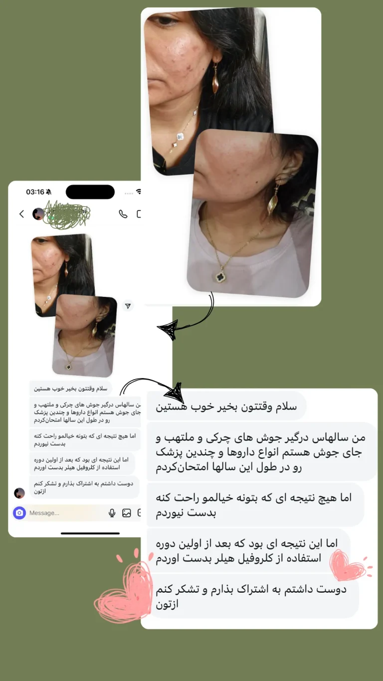 مقایسه پوست قبل و بعد از کلروفیل مایع هیلر